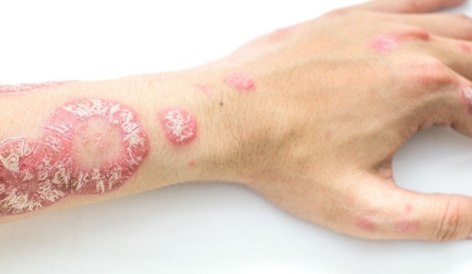 “Psoriasis! The skin disease we risk! ”