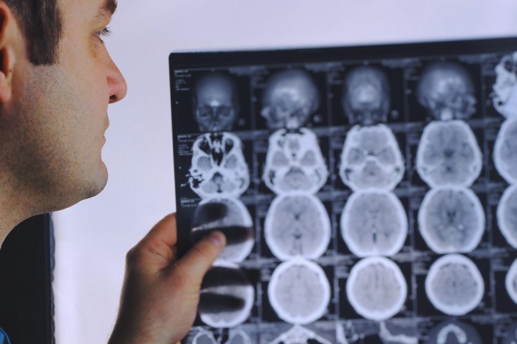 Study / Overweight Severely Impairs Memory