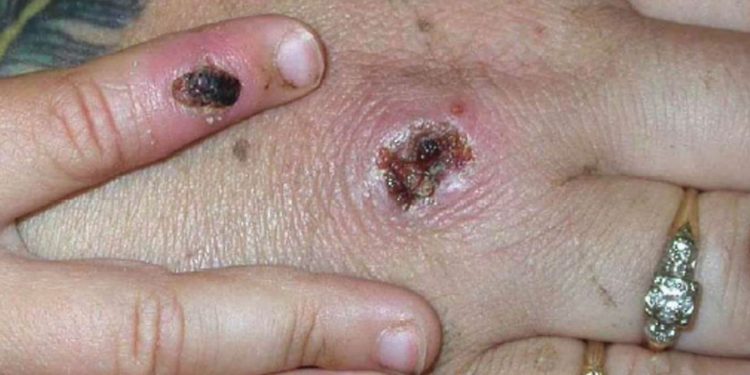 Vaccination against smallpox, if monkey pox appears, close contacts will be vaccinated