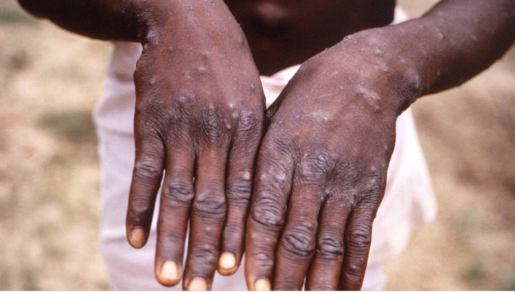 Spain with 30 cases of monkey pox, related to the sauna