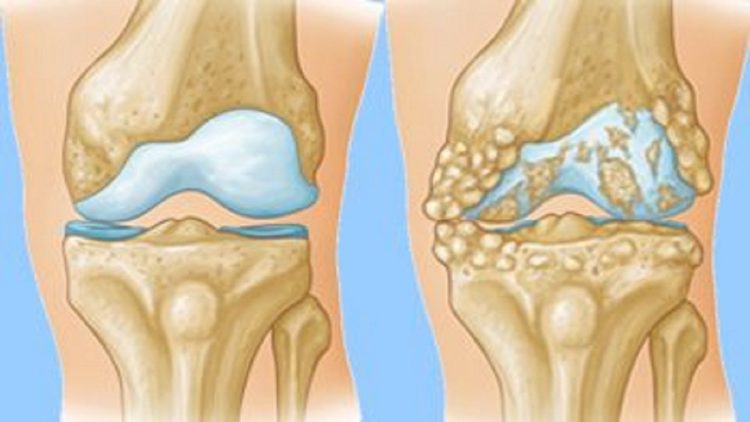 Crystallized glucosamine sulfate, the most widely used alternative in the treatment of osteoarthritis
