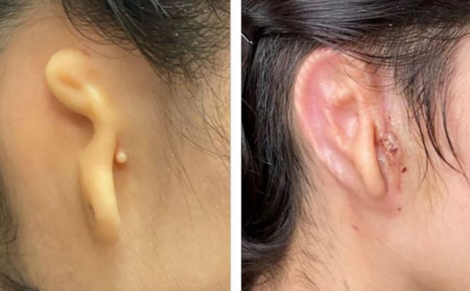 For the first time in the world, the first ear transplant is performed with 3D technology!
