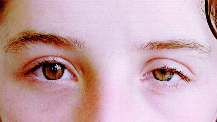 Drop of Eyelids. Not just an aesthetic problem!