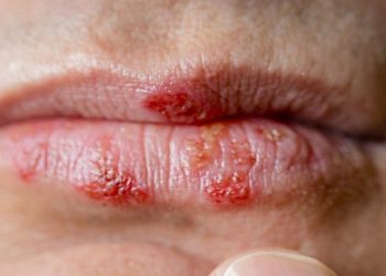 Why does herpes appear on the lips?  How to prevent and treat it