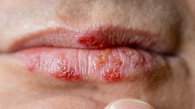 Why does herpes appear on the lips? How to prevent and treat it