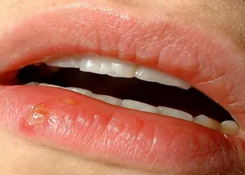 Why does herpes appear on the lips?  How to prevent and treat it