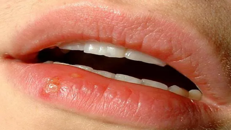 Why does herpes appear on the lips? How to prevent and treat it