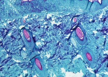 It is not transmitted as easily as Covid19!  What is “Monkey Pox” and how to get it