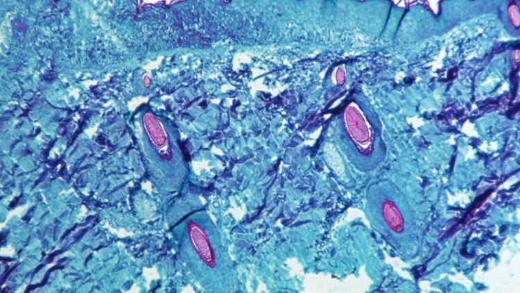 It is not transmitted as easily as Covid19! What is “Monkey Pox” and how to get it