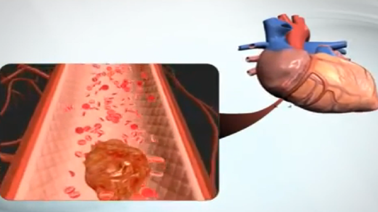 Covid also damaged the heart! Soon in Albania the drug that helps patients with heart failure
